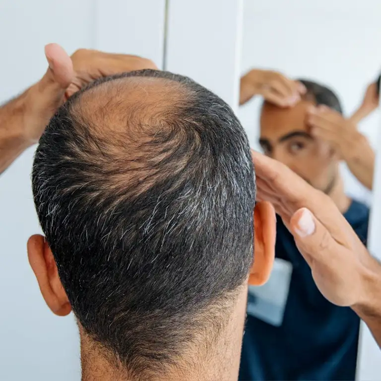 stem cell hair loss treatment in jotem beauty clinic - درمان تخصصی ریزش مو از طریق سلول های بنیادی و بایوتک 3