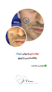 see some of our success skin rejuvenation resaults by jotem clinic - نمونه های موفق جوانسازی پوست با روش بایوتک در کلینیک زیبایی ژتم