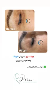 see some of our success skin rejuvenation resaults by jotem clinic - نمونه های موفق جوانسازی پوست با روش بایوتک در کلینیک زیبایی ژتم