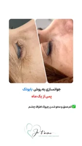 see some of our success skin rejuvenation resaults by jotem clinic - نمونه های موفق جوانسازی پوست با روش بایوتک در کلینیک زیبایی ژتم