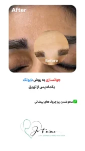 see some of our success skin rejuvenation resaults by jotem clinic - نمونه های موفق جوانسازی پوست با روش بایوتک در کلینیک زیبایی ژتم