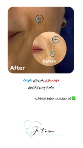 see some of our success skin rejuvenation resaults by jotem clinic - نمونه های موفق جوانسازی پوست با روش بایوتک در کلینیک زیبایی ژتم