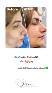 see some of our success skin rejuvenation resaults by jotem clinic - نمونه های موفق جوانسازی پوست با روش بایوتک در کلینیک زیبایی ژتم