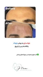 see some of our success skin rejuvenation resaults by jotem clinic - نمونه های موفق جوانسازی پوست با روش بایوتک در کلینیک زیبایی ژتم