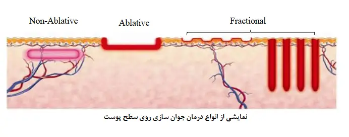 a-demonstration-of-skin-rejuvenation-treatment-using-hair-removal-laser - نمایش انواع جوانسازی پوست