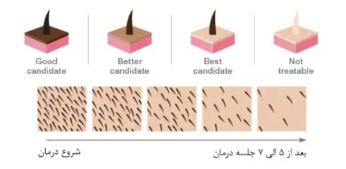 نحوه حذف موهای زائد توسط لیزر - hair-removal-by-laser