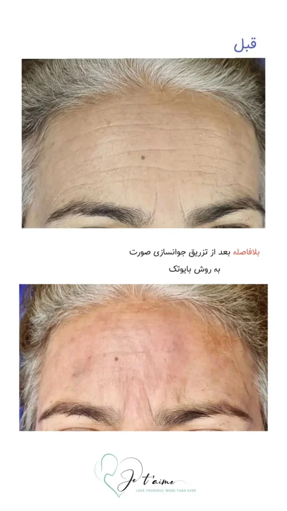 hand,neck and face skin rejuvenation in jotem clinic in isfahan - خدمات جوانسازی پوست دست، گردن و صورت در کلینیک ژتم در اصفهان - جوان سازی