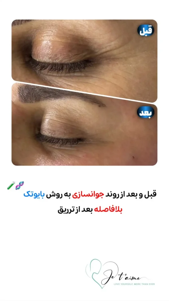 hand,neck and face skin rejuvenation in jotem clinic in isfahan - خدمات جوانسازی پوست دست، گردن و صورت در کلینیک ژتم در اصفهان - جوان سازی