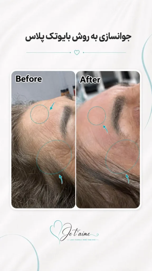 hand,neck and face skin rejuvenation in jotem clinic in isfahan - خدمات جوانسازی پوست دست، گردن و صورت در کلینیک ژتم در اصفهان - جوان سازی
