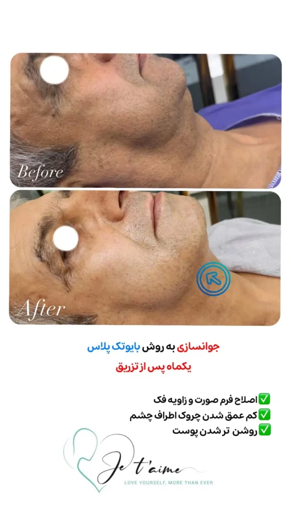 hand,neck and face skin rejuvenation in jotem clinic in isfahan - خدمات جوانسازی پوست دست، گردن و صورت در کلینیک ژتم در اصفهان - جوان سازی