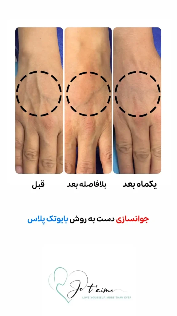hand,neck and face skin rejuvenation in jotem clinic in isfahan - خدمات جوانسازی پوست دست، گردن و صورت در کلینیک ژتم در اصفهان - جوان سازی