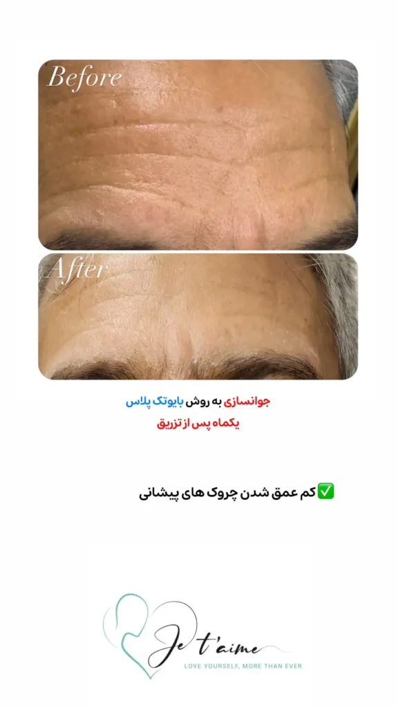 hand,neck and face skin rejuvenation in jotem clinic in isfahan - خدمات جوانسازی پوست دست، گردن و صورت در کلینیک ژتم در اصفهان - جوان سازی