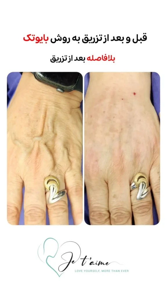 hand,neck and face skin rejuvenation in jotem clinic in isfahan - خدمات جوانسازی پوست دست، گردن و صورت در کلینیک ژتم در اصفهان - جوان سازی