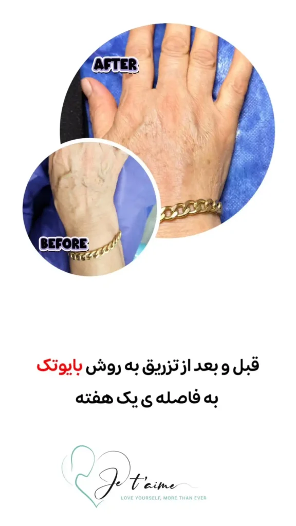 hand,neck and face skin rejuvenation in jotem clinic in isfahan - خدمات جوانسازی پوست دست، گردن و صورت در کلینیک ژتم در اصفهان - جوان سازی