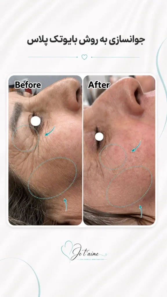 hand,neck and face skin rejuvenation in jotem clinic in isfahan - خدمات جوانسازی پوست دست، گردن و صورت در کلینیک ژتم در اصفهان - جوان سازی
