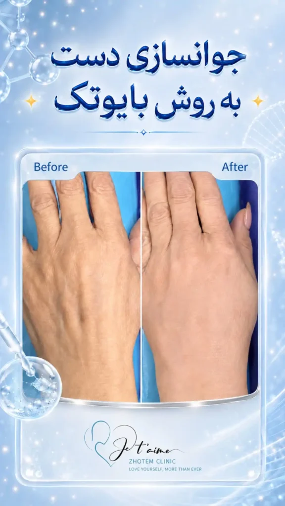 hand,neck and face skin rejuvenation in jotem clinic in isfahan - خدمات جوانسازی پوست دست، گردن و صورت در کلینیک ژتم در اصفهان - جوان سازی